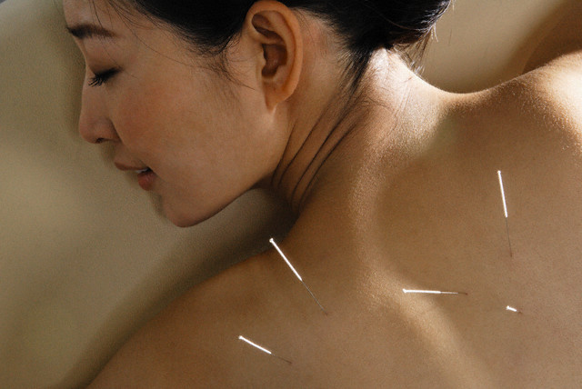 mulher recebendo acupuntura